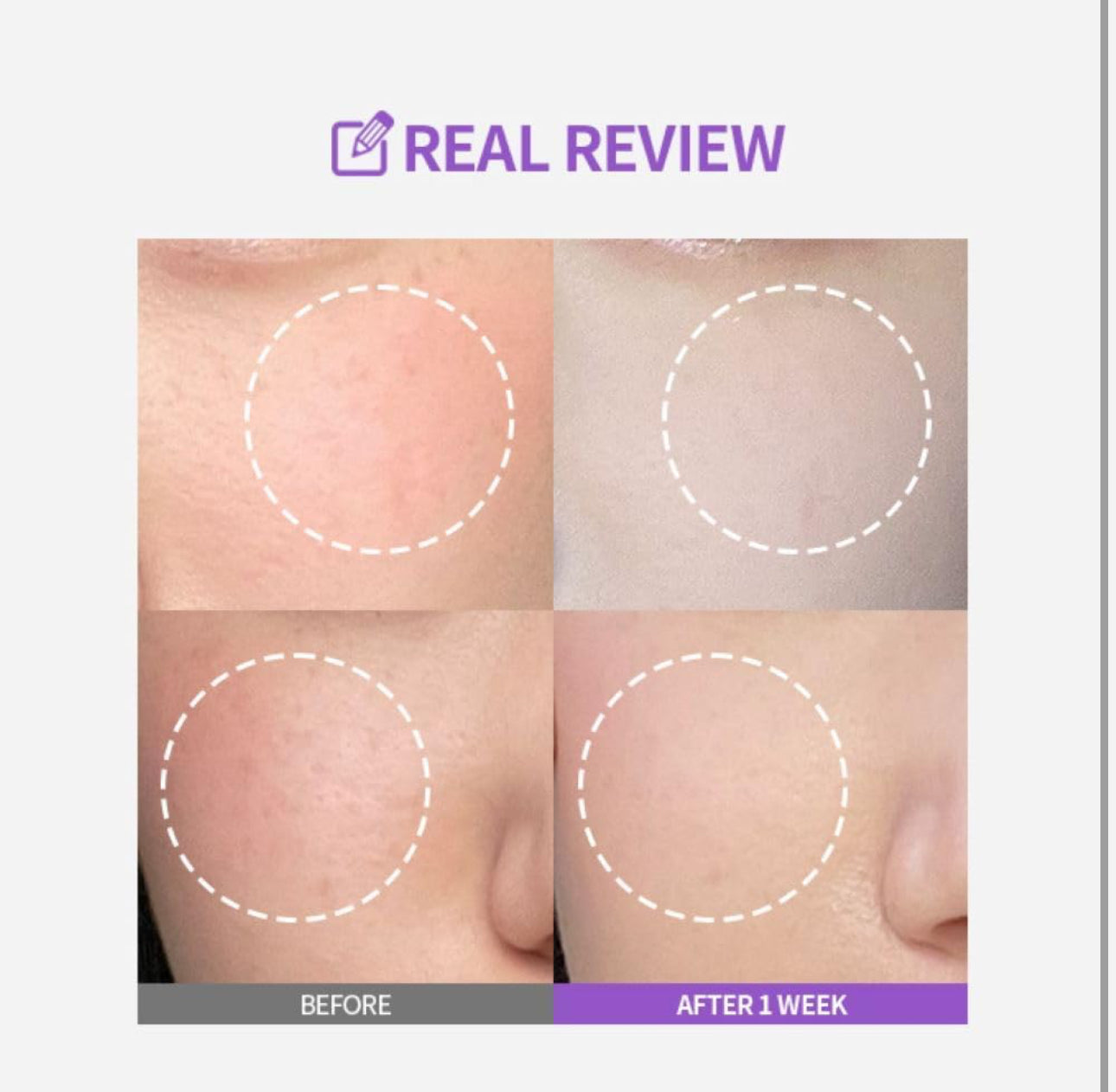 Before and after comparison of skin treatment on a person's face with 'Real Review' branding.