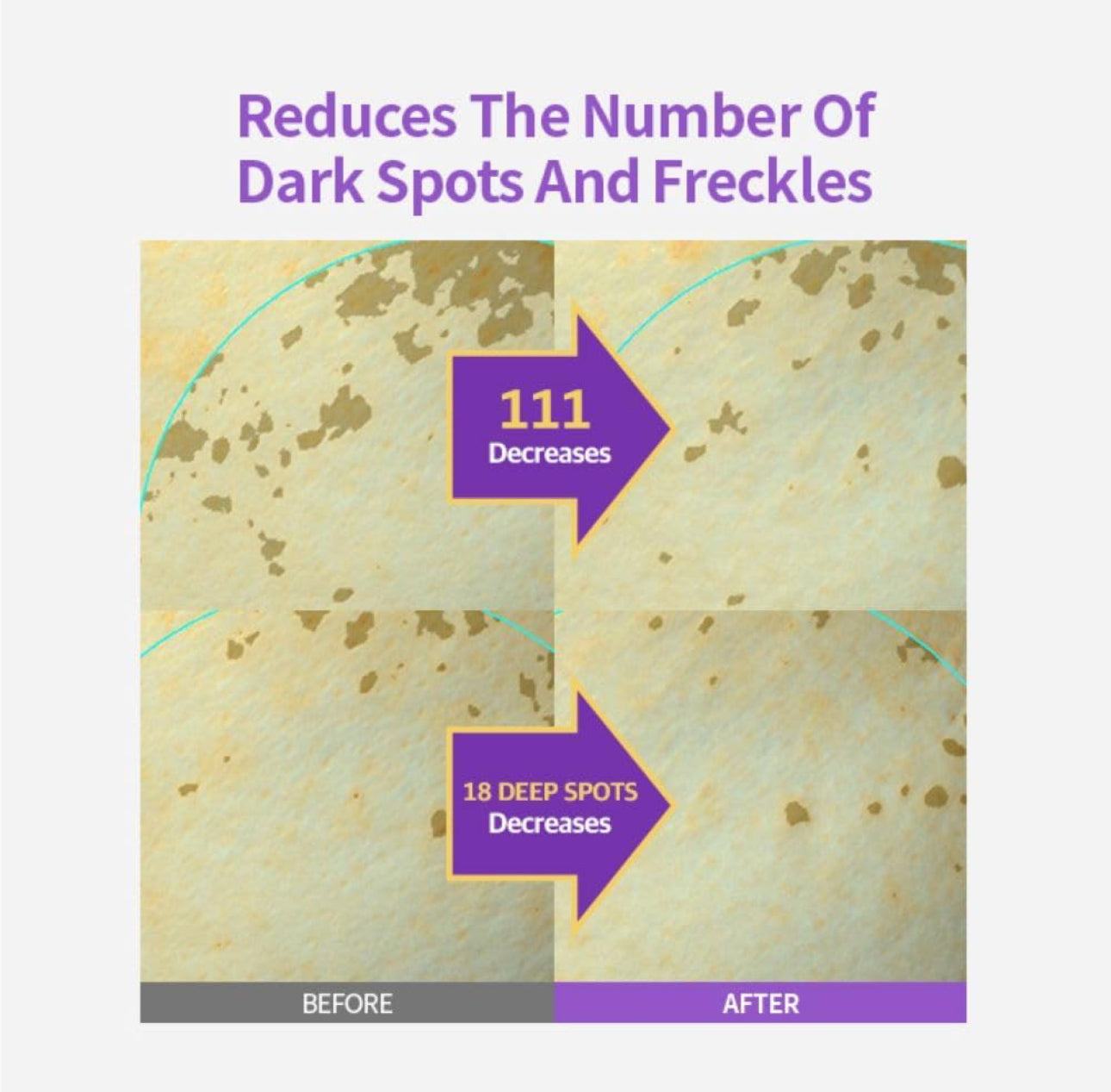 Before and after comparison of skin with dark spots and freckles, showing a decrease in their number.